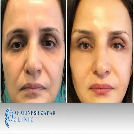 ماندگاری تزریق چربی و ژل